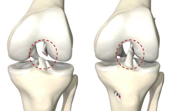 Knee Replacement Doctor In Jaipur