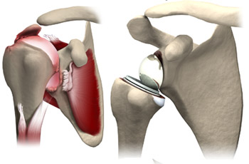 Knee Replacement Doctor In Jaipur