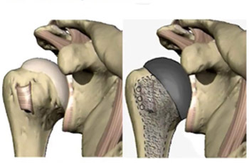 Knee Replacement Doctor In Jaipur