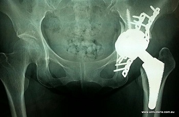 Knee Replacement Doctor