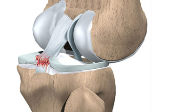 Knee Replacement Doctor In Jaipur