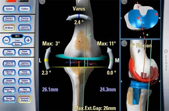 Knee Replacement Doctor
