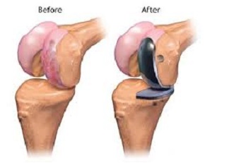 Knee Replacement Doctor