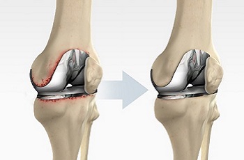 Knee Replacement Doctor