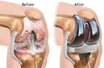 Knee Replacement Doctor