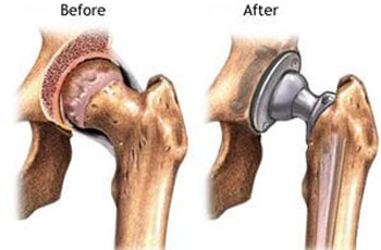 Knee Replacement Doctor